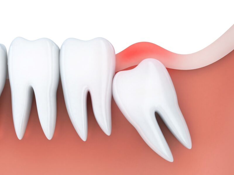 Wisdom teeth are the third molars that usually appear in your late teens or early twenties. But not everyone has them. Find out why and what to do if you have them.